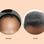 Hair-transplant_1@300x-100-scaled.webp.bv_resized_desktop.webp.bv